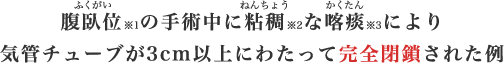 腹臥位の手術中に粘稠な喀痰により気管チューブが3cm以上にわたって完全閉鎖された例